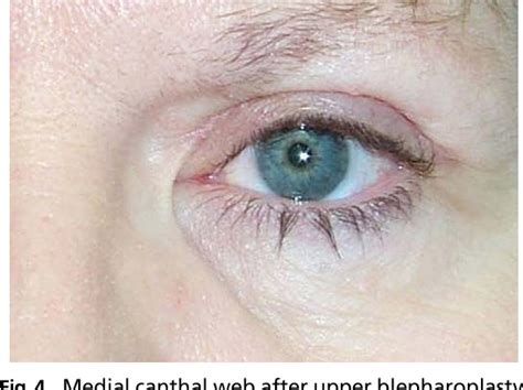 Patients typically are seen after blepharoplasty surgery or trauma with both cosmetic and functional (visual-field obstruction in lateral gaze) deficits. . Medial canthal webbing after blepharoplasty